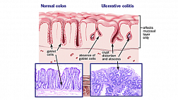 НЯК. Клинический случай / clinical case. Нижние отделы